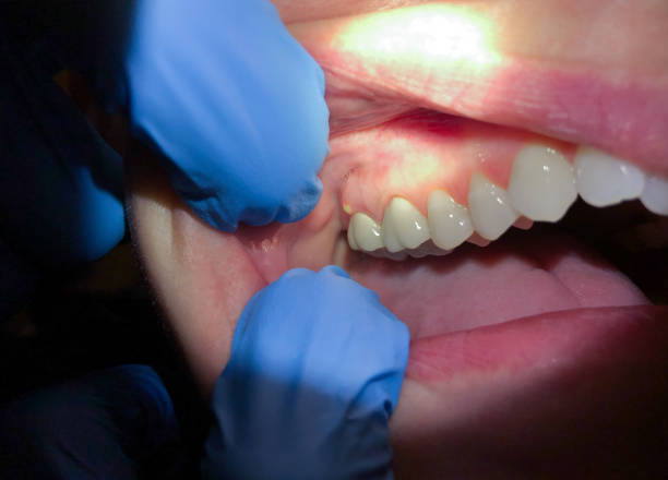 Best Urgent Tooth Repair  in North Bend, OH